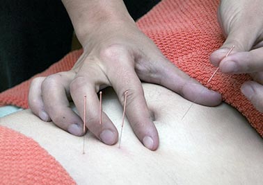 L'acupuncture, un allié pour la santé